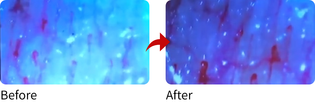 30代女性　毛細血管：酸素BOX利用