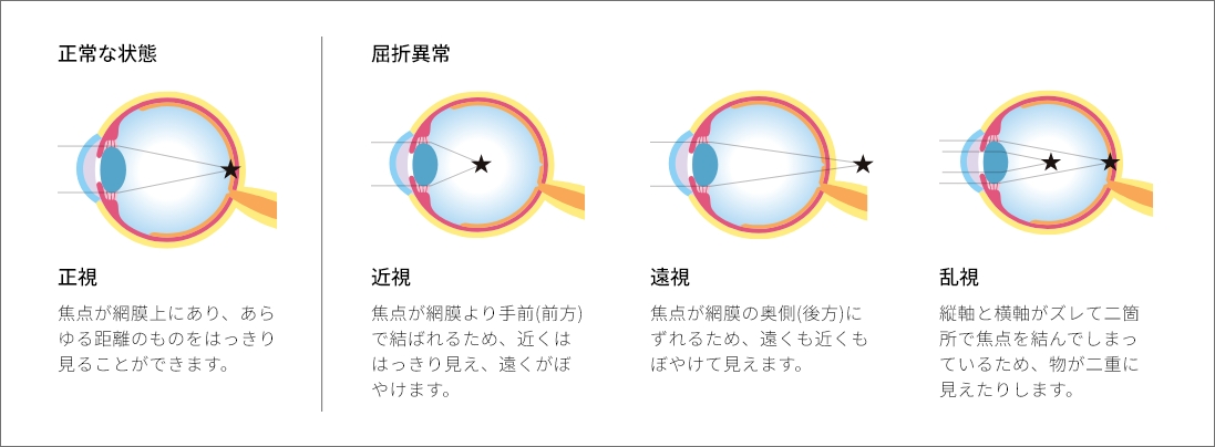 正常な状態の目と屈折異常の違いを説明する図